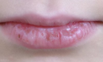 ​秋冬季嘴唇干裂起皮，你对慢性唇炎的疑惑都在这里
