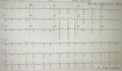 心电图8合集丨8份心电图让您轻松搞定房颤、房扑、房速