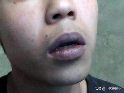 嘴唇颜色暗怎么调理中医 嘴唇发暗吃什么药好