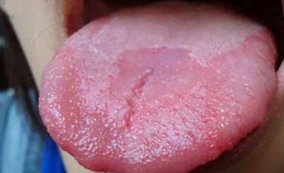 ​什么是地图舌？