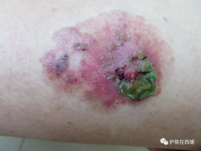 ​Bowen病——不痛不痒却是皮肤癌